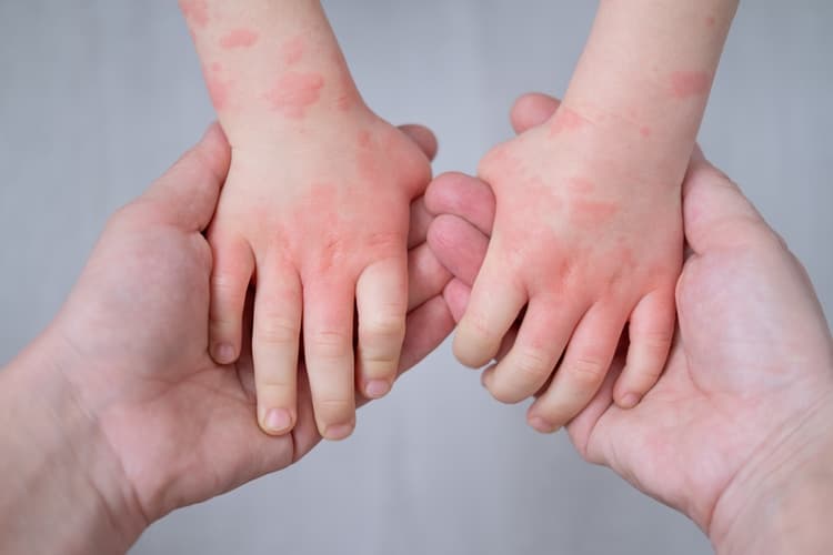 What Is A Food Allergy? Promoting Better Awareness This Upcoming Food Allergy Week - Featured blog post image for LFA First Response