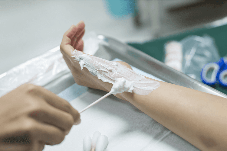 Diagnosing and Treating Burns - Practical First Aid For Burns - Featured blog post image for LFA First Response
