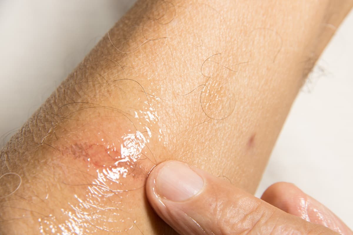 How to Treat Minor Burns - Featured blog post image for LFA First Response