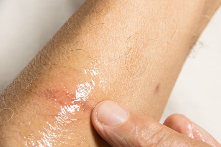 How to Treat Minor Burns - Featured blog post image for LFA First Response