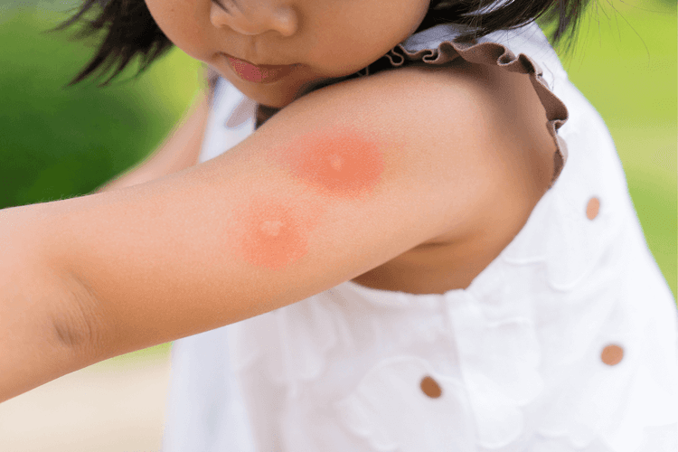 Our Guide to Australian Insect Bites – How to Identify and Treat Them - Featured blog post image for LFA First Response